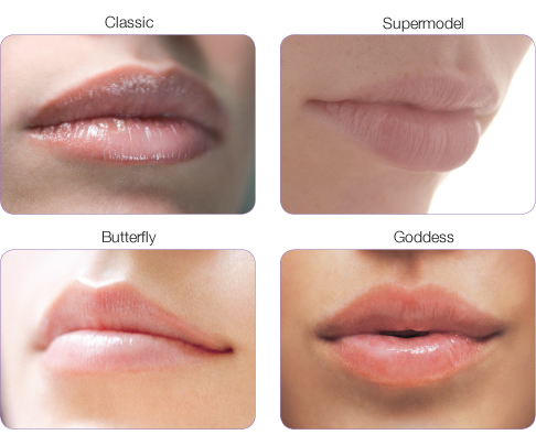 Juvederm-enhancement-for-lips