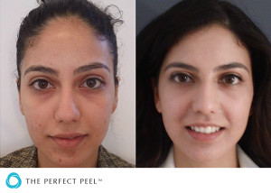 TPP_before_and_after_03